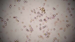 Fungal Infections