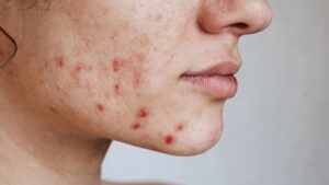 Scar and Dark Spot Fading