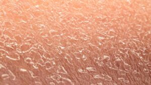 Skin Condition
