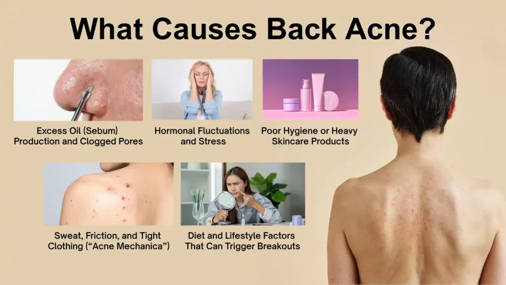 what causes back acne