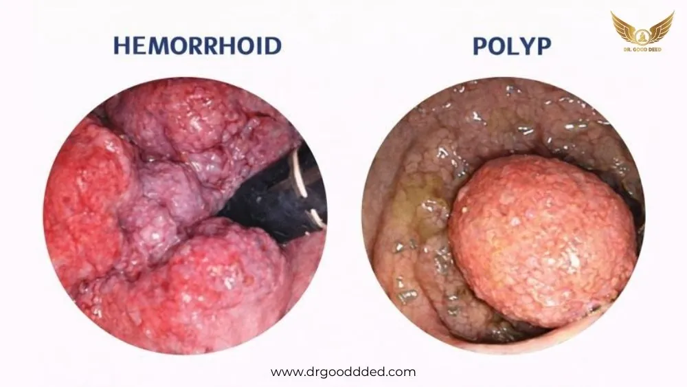 Difference Between Hemorrhoid And Polyp