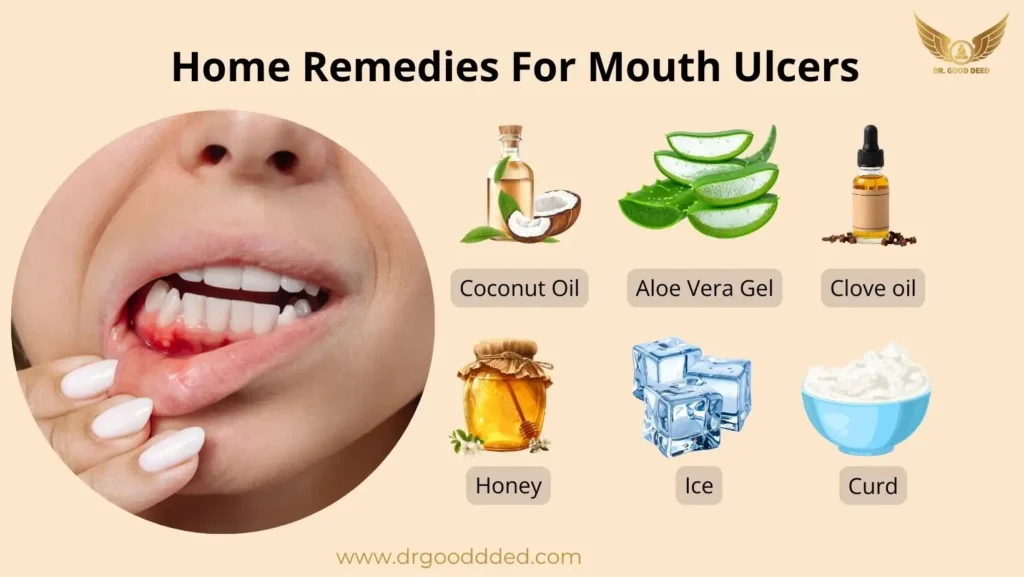Natural Remedies For Mouth Ulcers