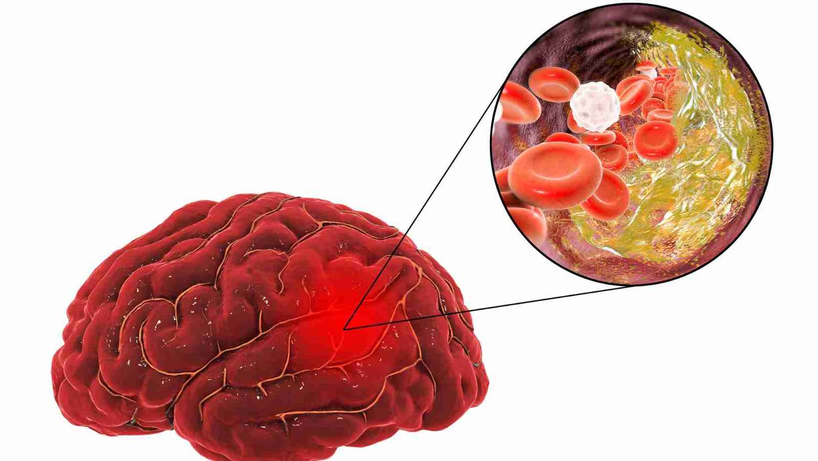 What is brain clot