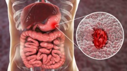 Uncover the Link Between Stress, Lifestyle Choices, and Ulcer