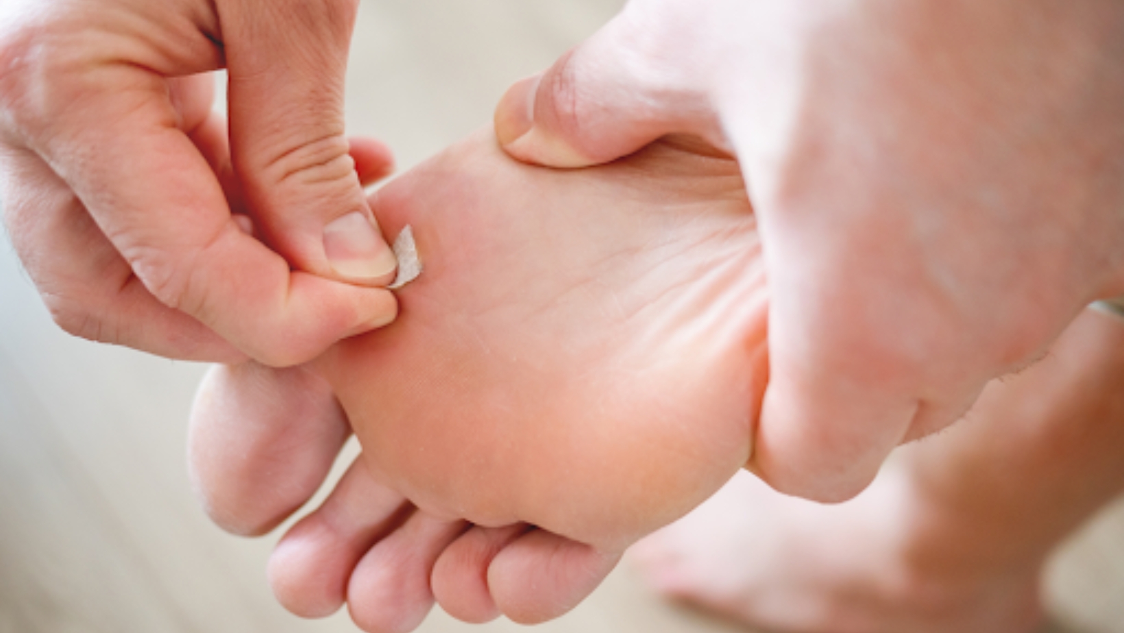 Warts Be Gone Remover! Natural Cures That Really Work