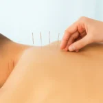 The Complete Guide to Acupuncture: Treatment, Benefits, and Risks