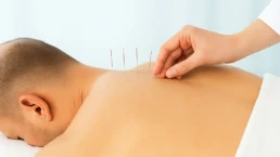 acupuncture