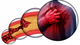 obesity and heart disease
