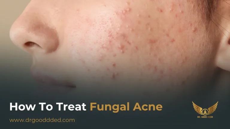 How to Treat Fungal Acne: Expert-Approved Causes, Symptoms & Remedies