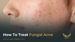 how to treat fungal acne