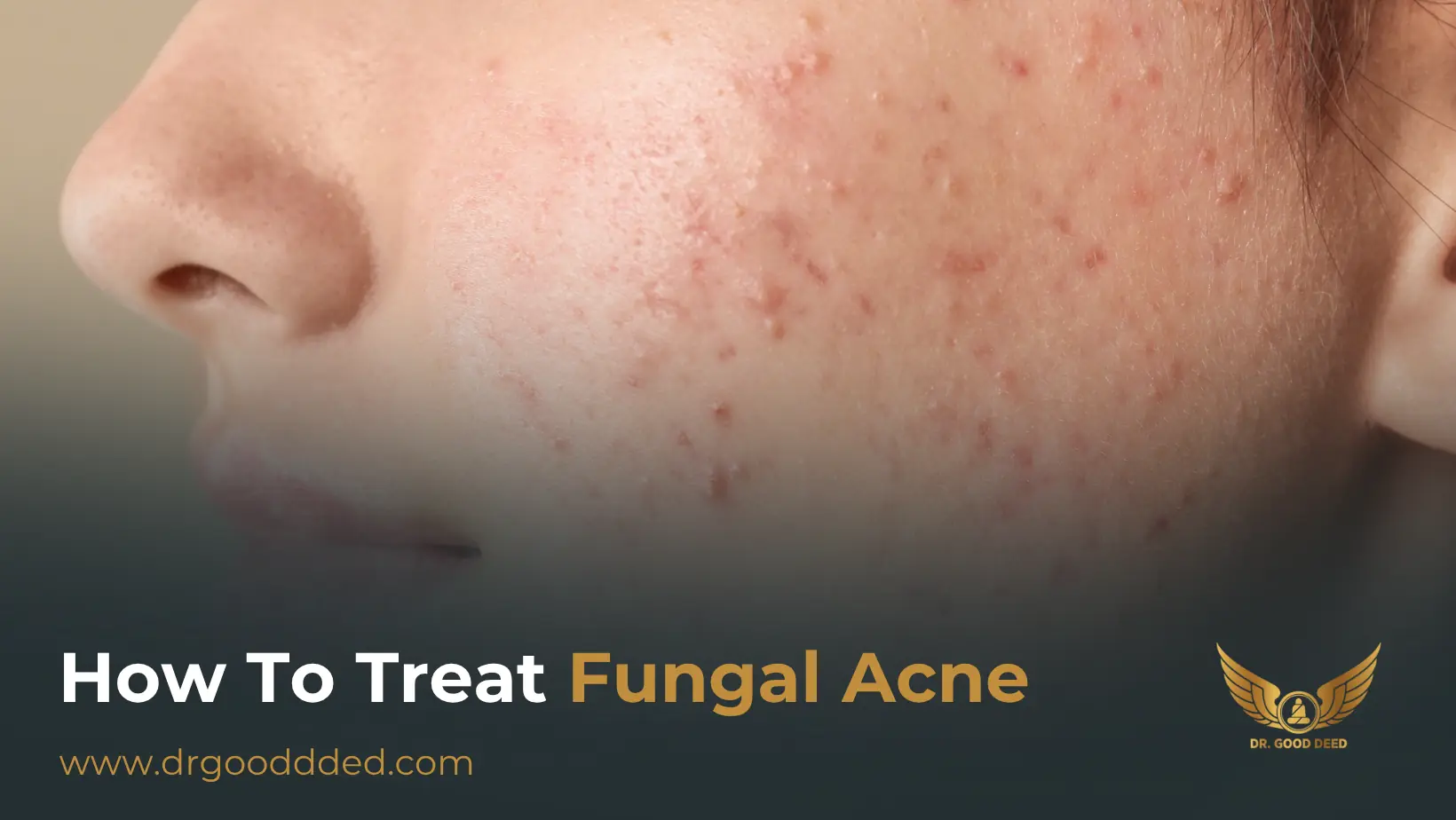 How to Treat Fungal Acne: Expert-Approved Causes, Symptoms & Remedies