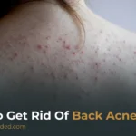 How to Get Rid of Back Acne: Causes, Treatments & Prevention Tips