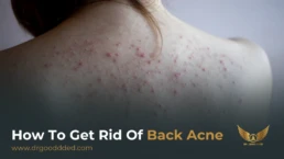 how to get rid of back acne