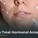 How to Treat Hormonal Acne: Causes, Effective Treatments & Prevention Tips