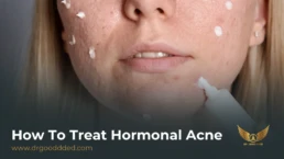 how to treat hormonal acne