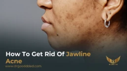 how to get rid of jawline acne