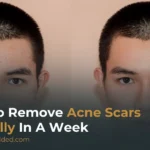 How To Remove Acne Scars Naturally In A Week: Expert-Approved Home Remedies