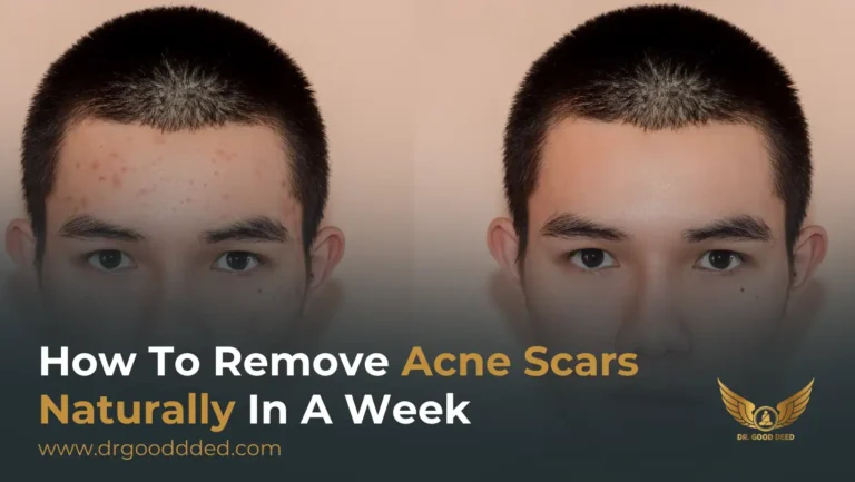 How To Remove Acne Scars Naturally In A Week: Expert-Approved Home Remedies