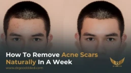 how to remove acne scars naturally in a week