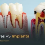 Dentures vs Implants: Understanding the Difference & Choosing What’s Right for You