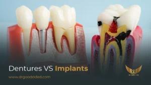 Dentures vs Implants: Understanding the Difference & Choosing What’s Right for You