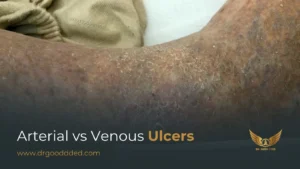 Arterial vs Venous Ulcers: Key Differences, Causes, and Treatments
