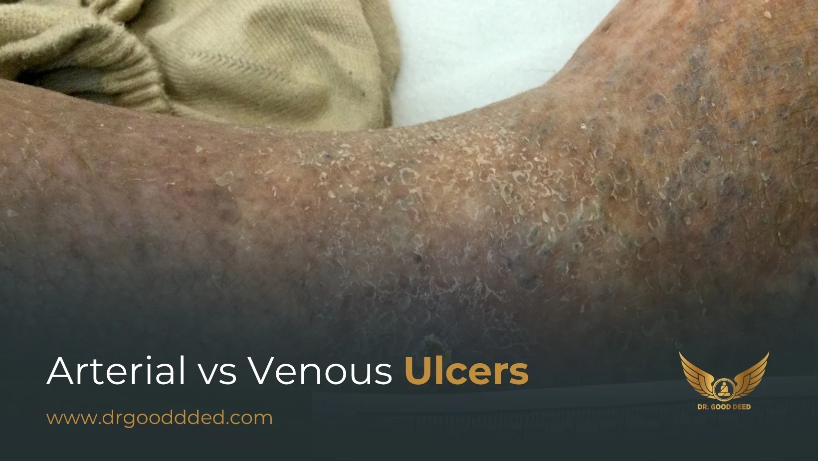 Arterial vs Venous Ulcers: Key Differences, Causes, and Treatments