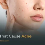 Foods That Cause Acne: What Science Says About Diet & Breakouts