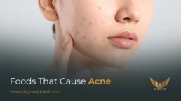Foods That Cause Acne