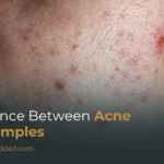 Difference Between Acne and Pimples: Symptoms, Causes & Treatment Differences