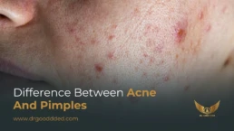Difference Between Acne and Pimples