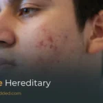 Is Acne Hereditary? Genetic Causes, Hormonal Influence & Family History Explained