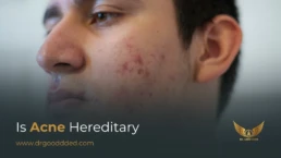 Is acne hereditary