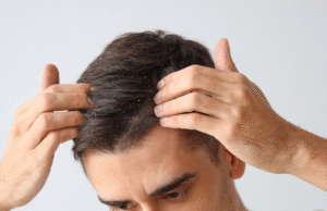 Top Causes of Dandruff and Effective Ways to Treat It