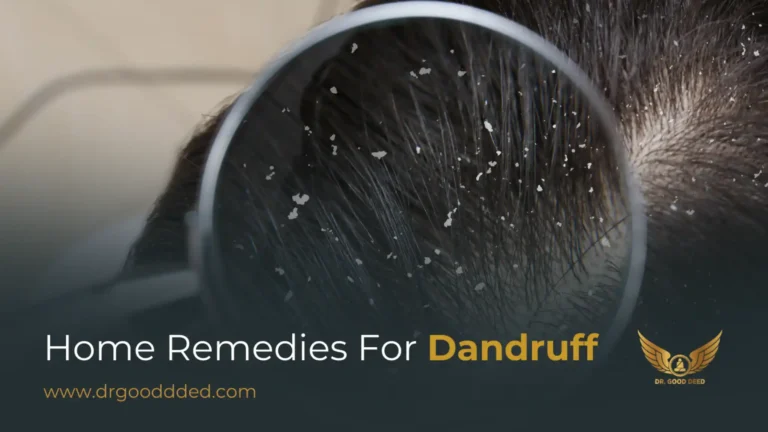 Home Remedies for Dandruff: Natural Ways to Treat a Flaky Scalp