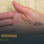 Pain In Stitches: Causes, Relief & When To Seek Care