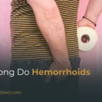 How Long Do Hemorrhoids Last? Duration, Flare-Ups & When to Seek Help