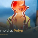 Hemorrhoid Vs Polyp: Differences, Symptoms, Causes & Diagnosis