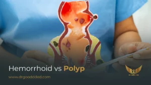Hemorrhoid Vs Polyp: Differences, Symptoms, Causes & Diagnosis