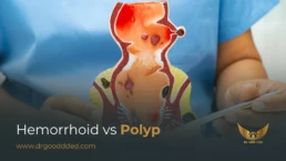 hemorrhoid vs polyp