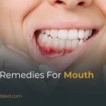 Home Remedies for Mouth Ulcers: Natural Treatments & Quick Relief