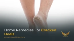 home remedies for cracked heels​