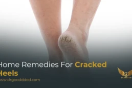 home remedies for cracked heels​