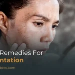 Home Remedies for Pigmentation: Natural Ways to Lighten Dark Spots