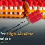 High Alkaline Phosphatase Levels: Causes You Should Not Ignore