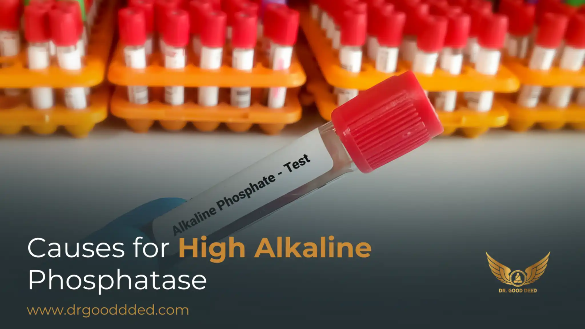 High Alkaline Phosphatase Levels: Causes You Should Not Ignore