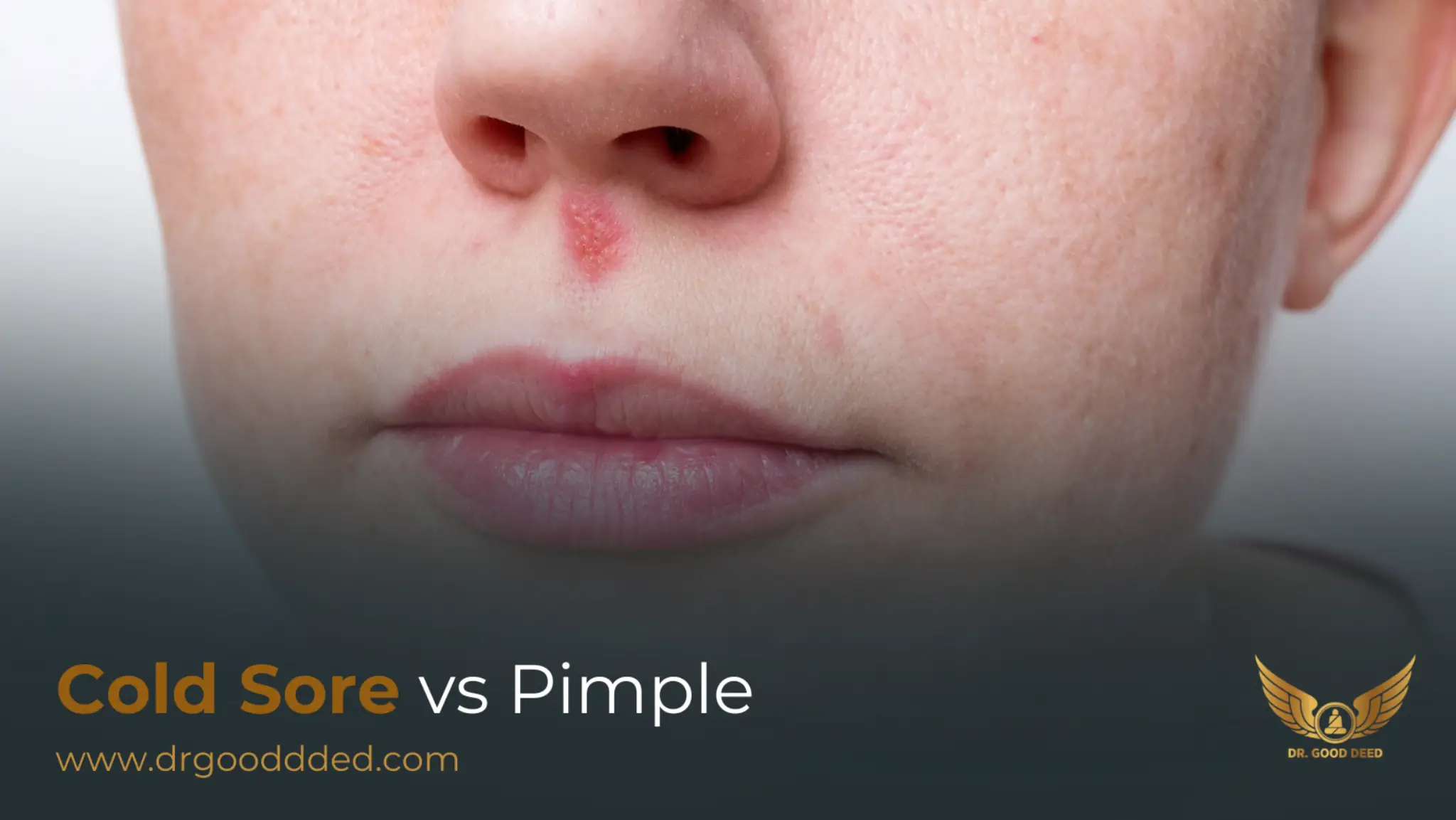 Cold Sore vs Pimple: How to Tell the Difference and Treatment