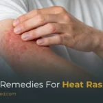 Natural Remedies for Heat Rash: 20 Remedies That Actually Work