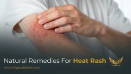 natural remedies for heat rash​