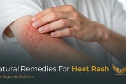 natural remedies for heat rash​